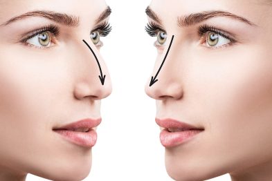 Bursa Rinoplasti Bursa Rinoplasti